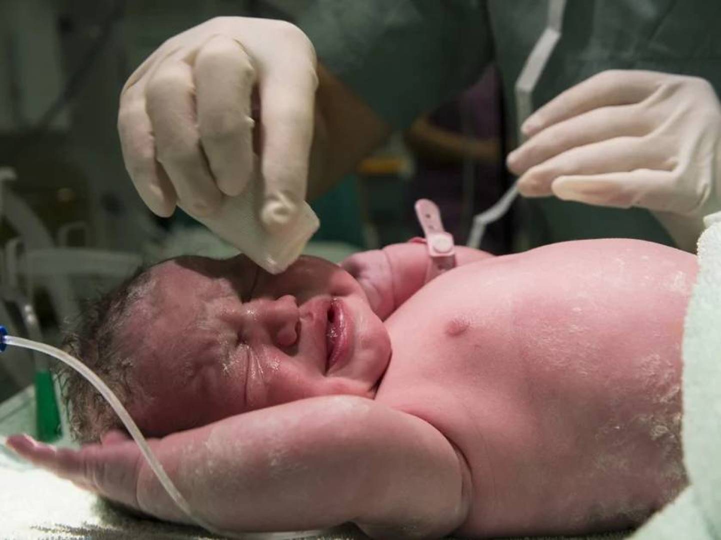 علماء يحددون مؤشرات حيوية قد تمنع الشلل الدماغي لدى الرضع