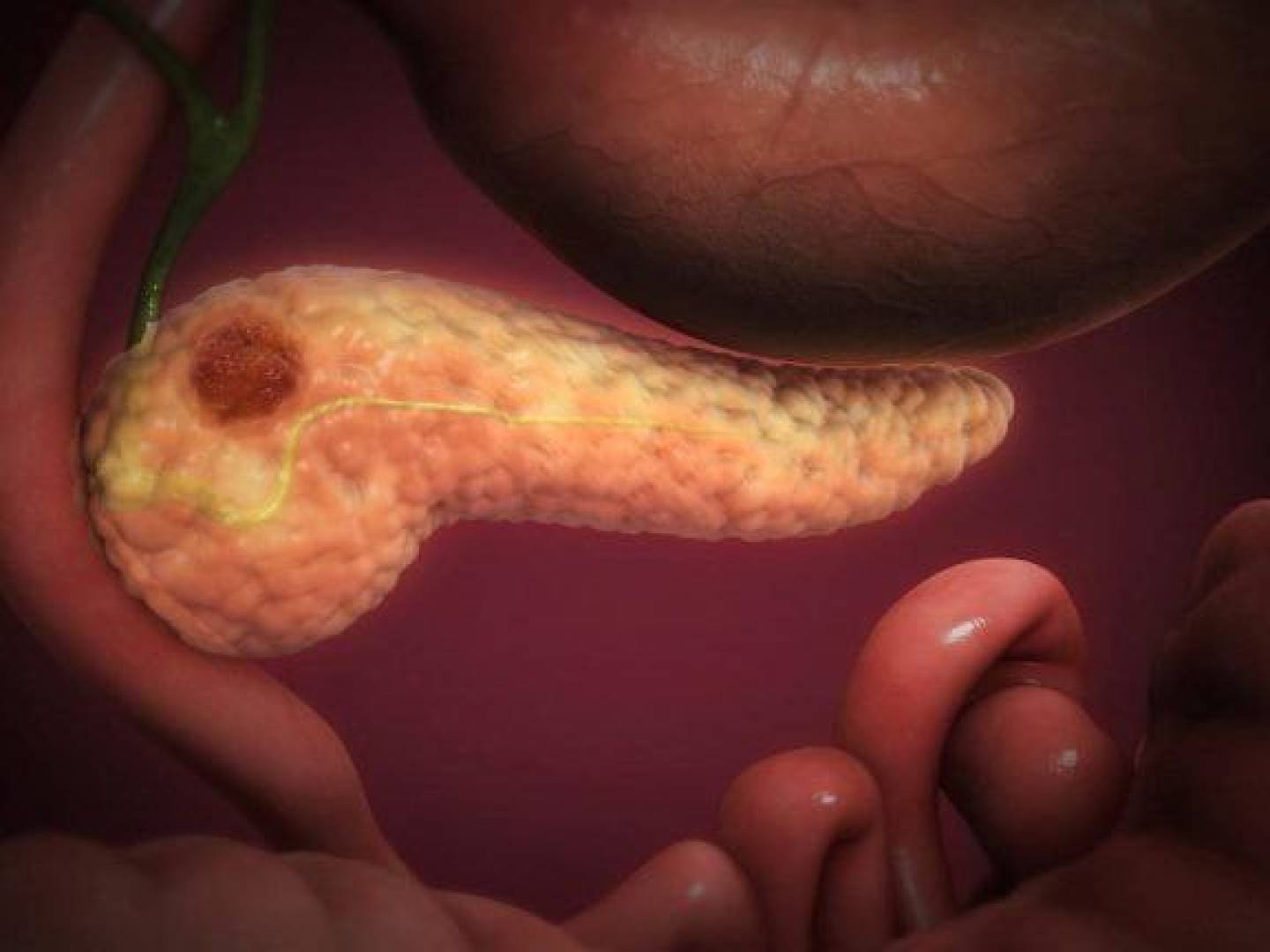 آلية خفية تساعد سرطان البنكرياس ليكون أكثر السرطانات فتكا وصعوبة في العلاج