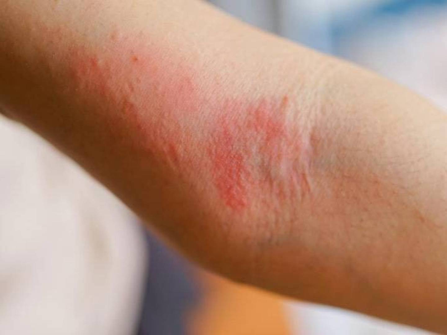 الكشف عن وجود مسار مباشر بين الدماغ والجلد يربط التوتر النفسي