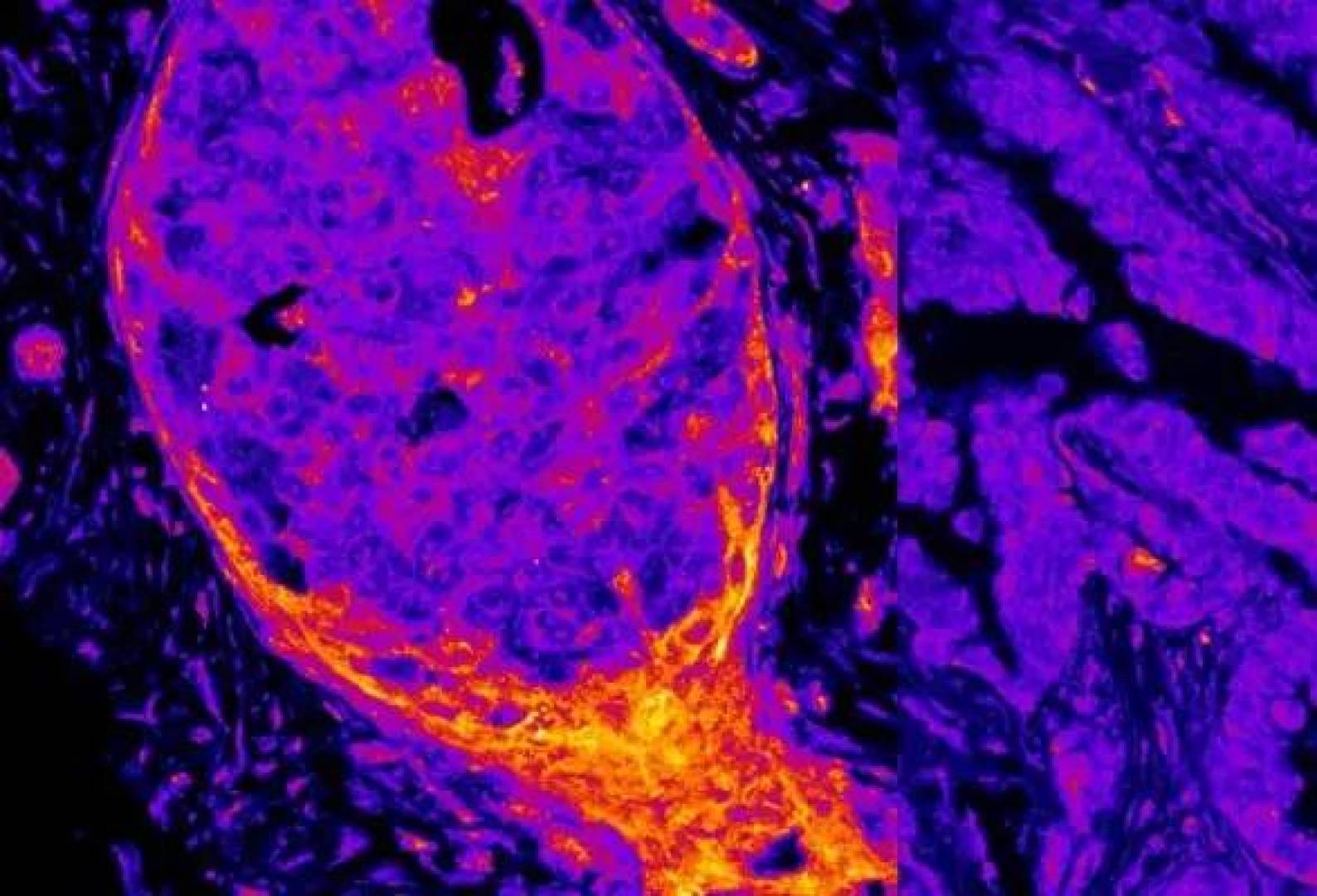 اكتشاف مئات الإنزيمات المرتبطة بالطاقة داخل نواة الخلية السرطانية قد تغير طرق العلاج