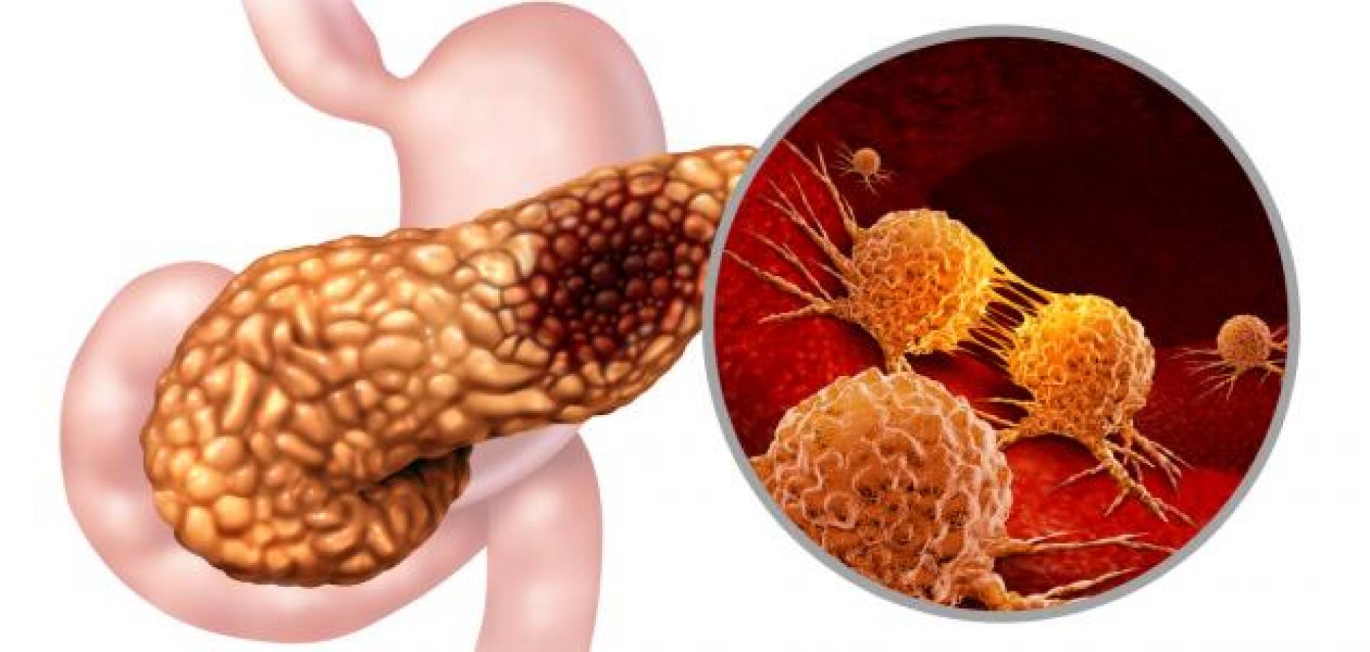 كيف يخدع سرطان البنكرياس المناعة قبل ظهوره؟ اكتشاف علمي جديد