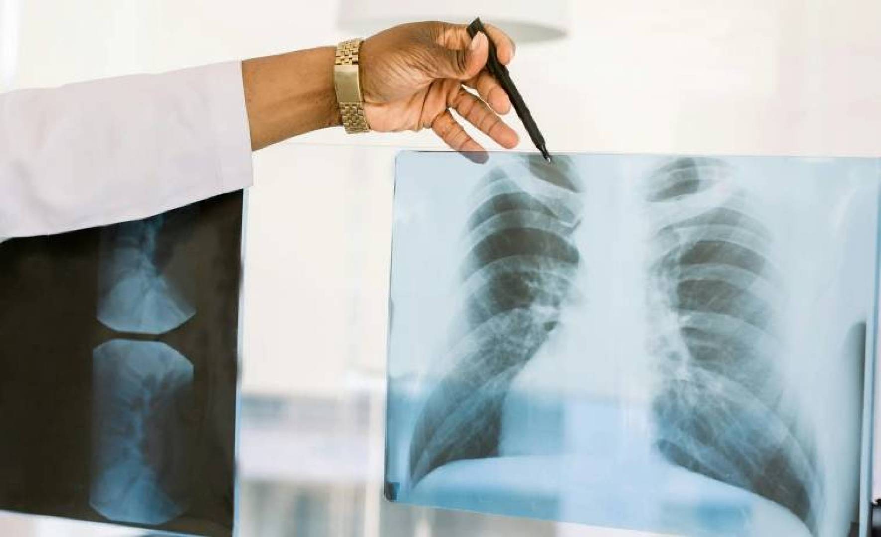 اكتشاف علاج ثوري جديد لبكتيريا السل