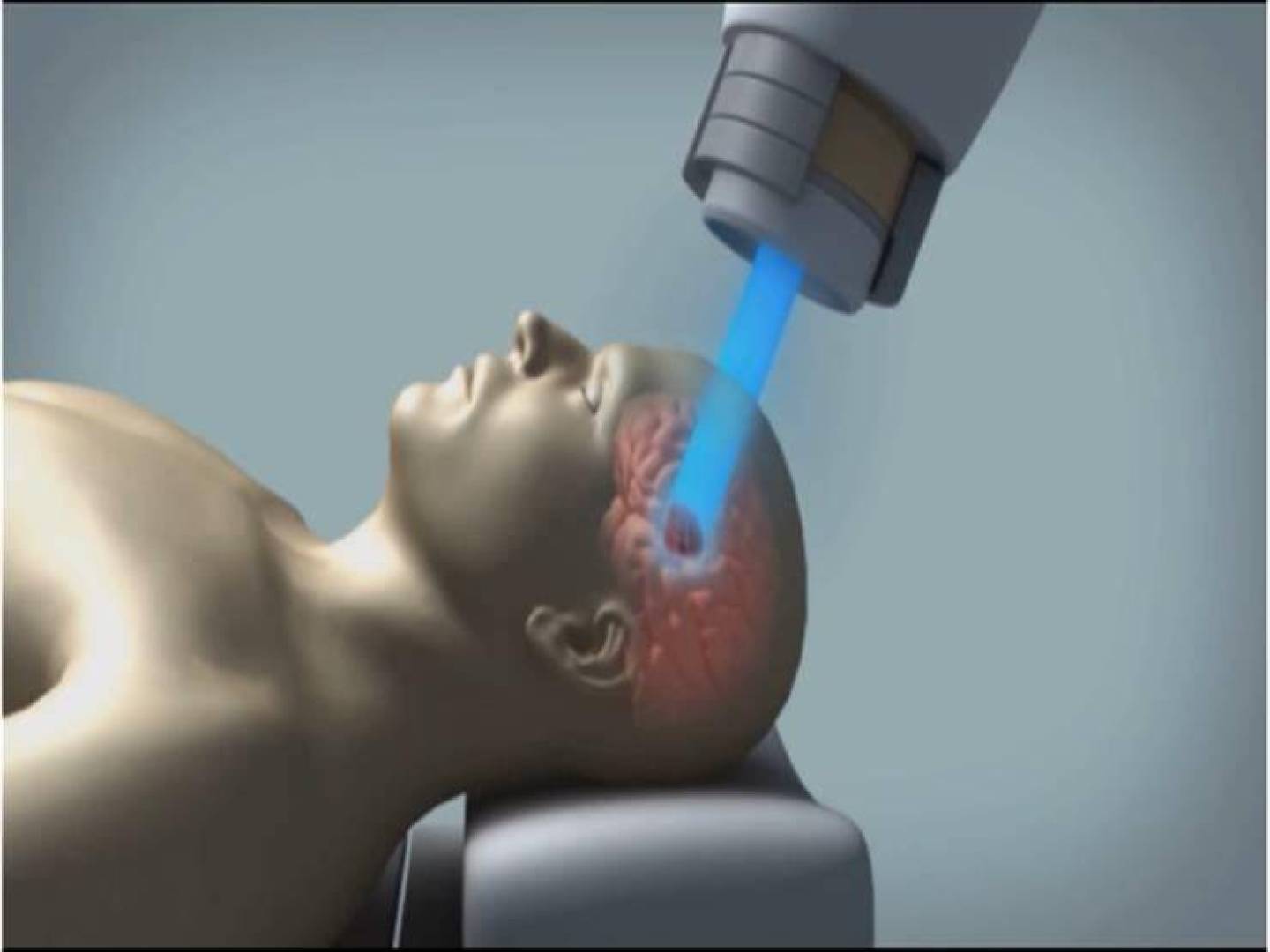 اختراق علمي قد يفتح باب علاج أورام صعبة