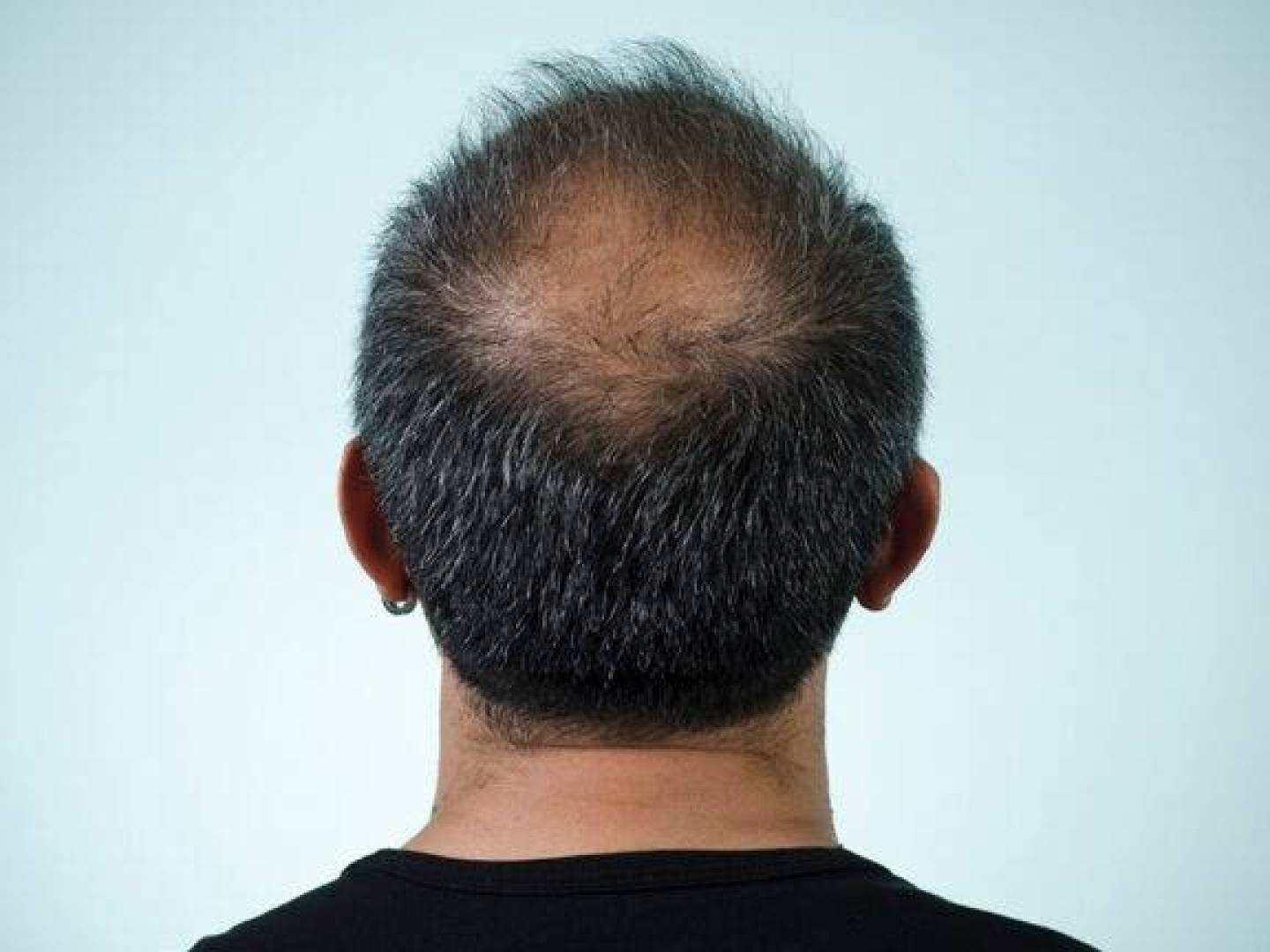 علماء ينجحون في إنماء بصيلات شعر تعمل طبيعيا داخل المختبر