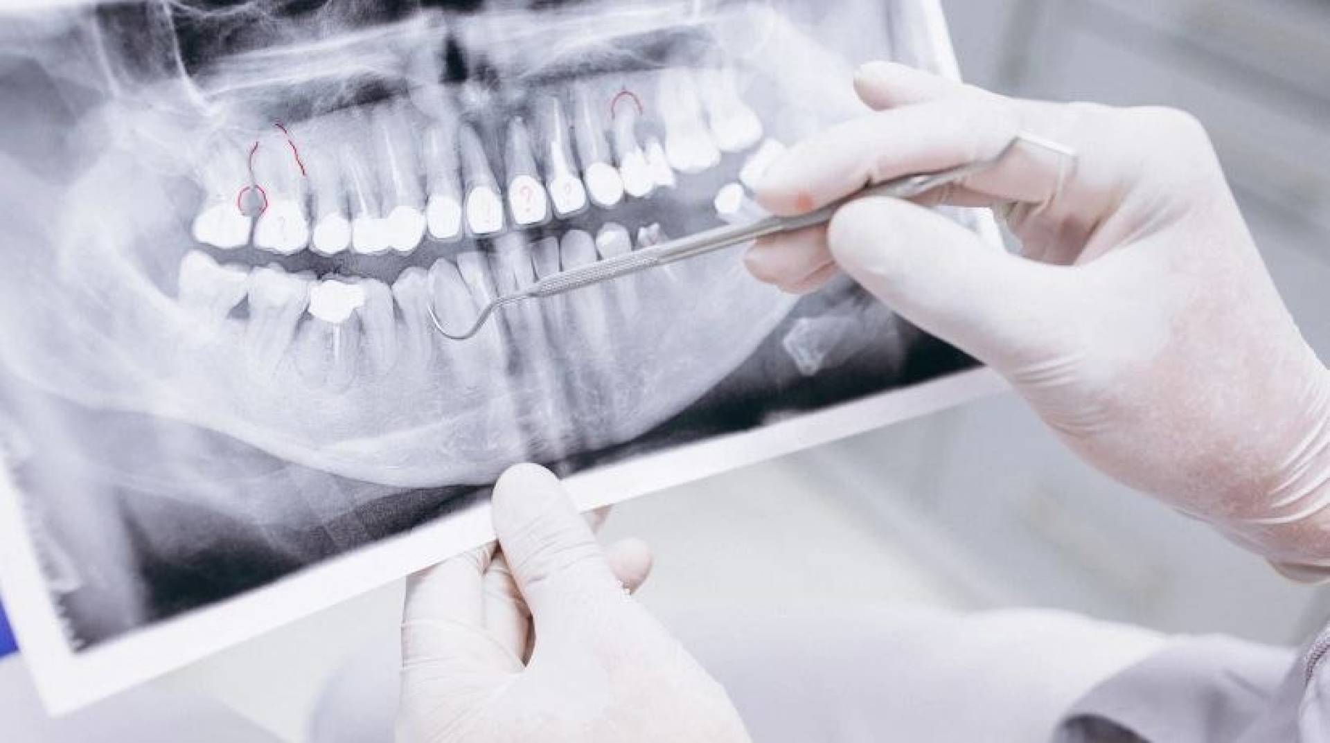 تجاهل علاج الأسنان قد يؤدي لأمراض القلب والخرف