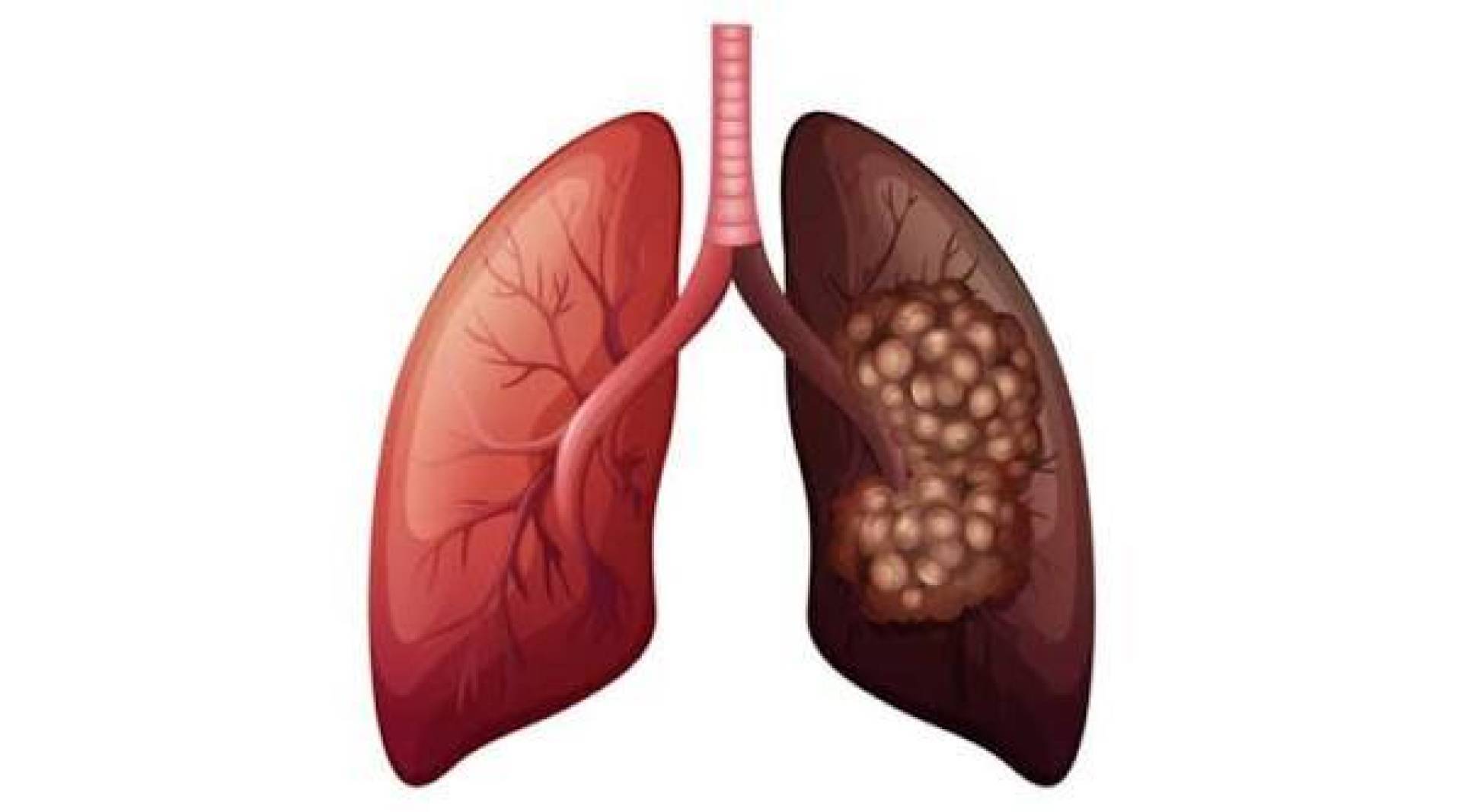 تقنية جديدة بالذكاء الاصطناعي تحدد فعالية علاجlمرض سرطان الرئة صغير الخلايا