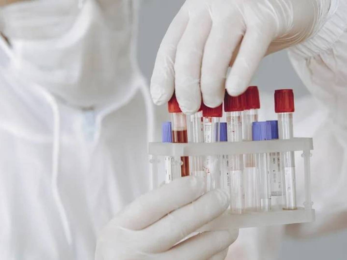 زراعة نخاع عظمي من شقيق تؤدي إلى هدوء طويل لفيروس HIV