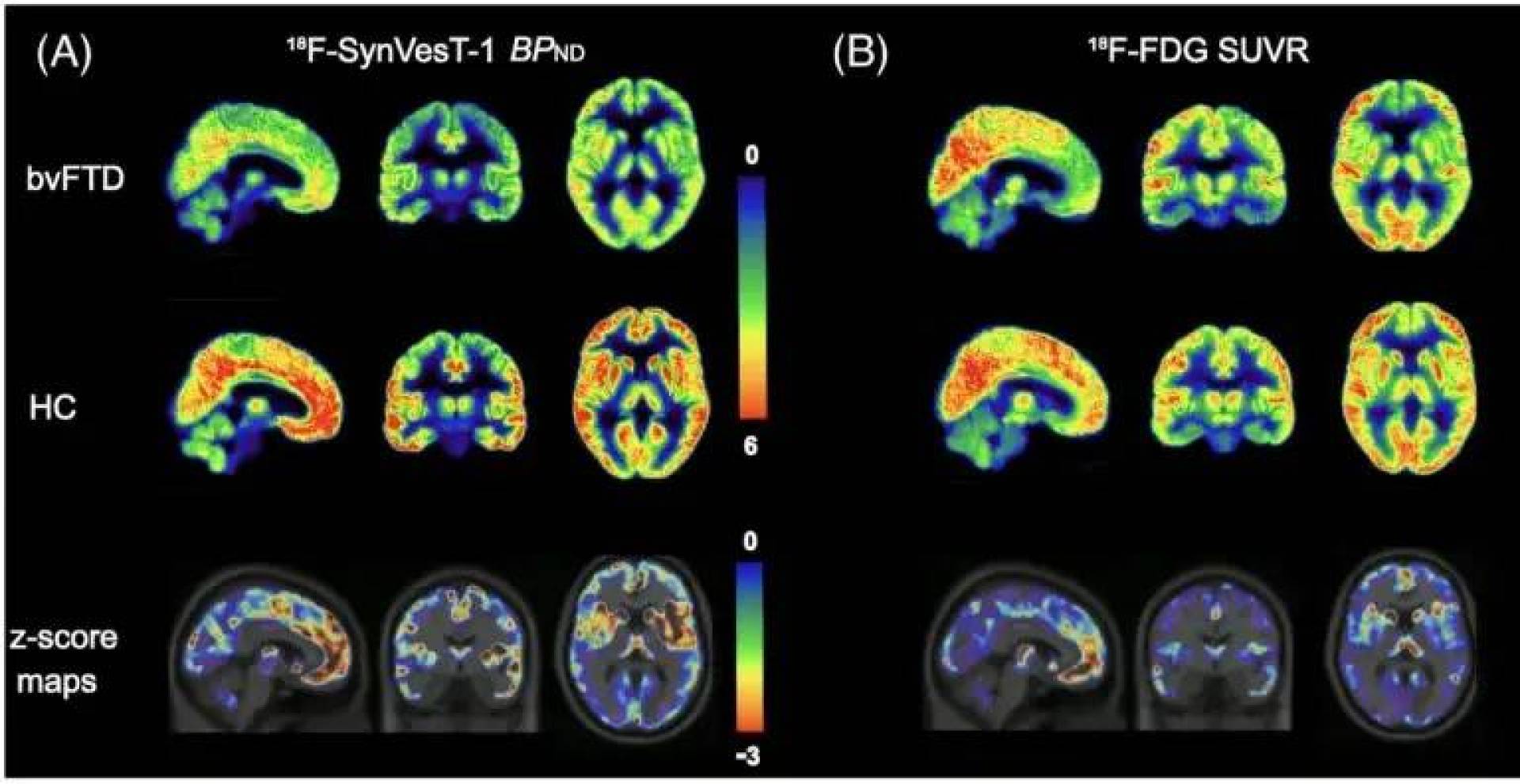 تطوير تقنية تصوير دماغي متقدمة تساعد في تشخيص الخرف مبكرا بدقة عالية