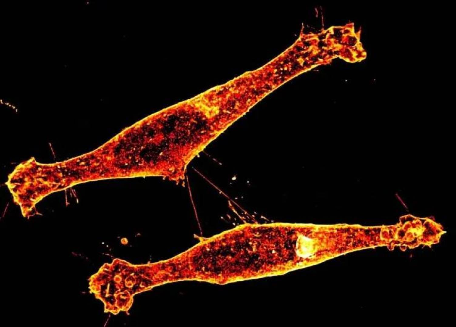 اكتشاف طبي لفهم انتشار مرض هنتنغتون