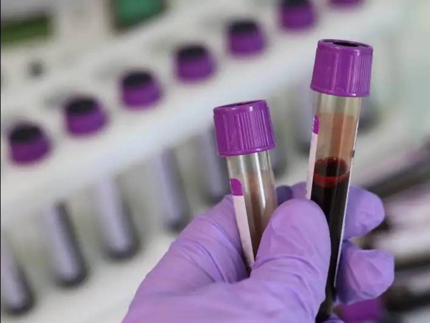 ابتكار طبي لتشخيص سرطان الدم دون خزعة نخاع العظم