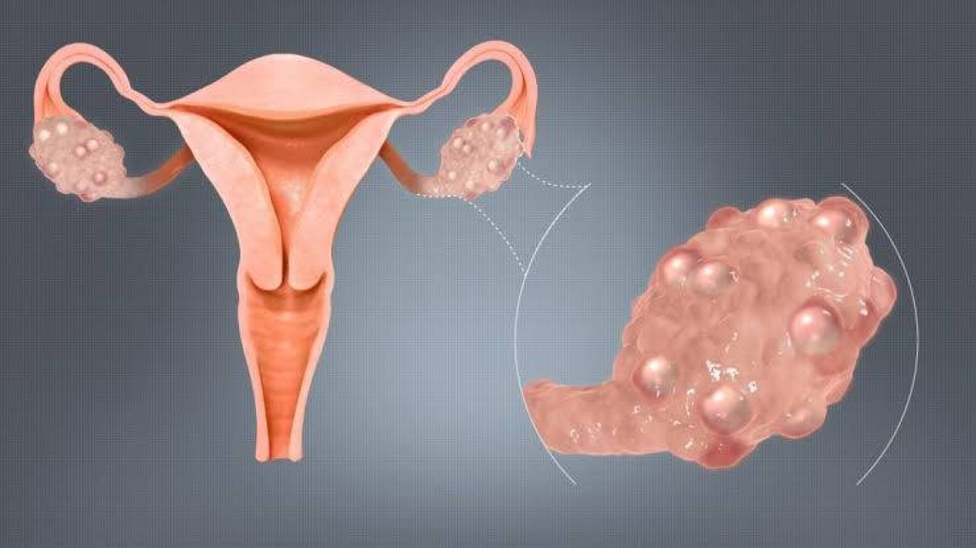 رسميا اسم جديد لمتلازمة تكيس المبايض يعكس حقيقتها الطبية