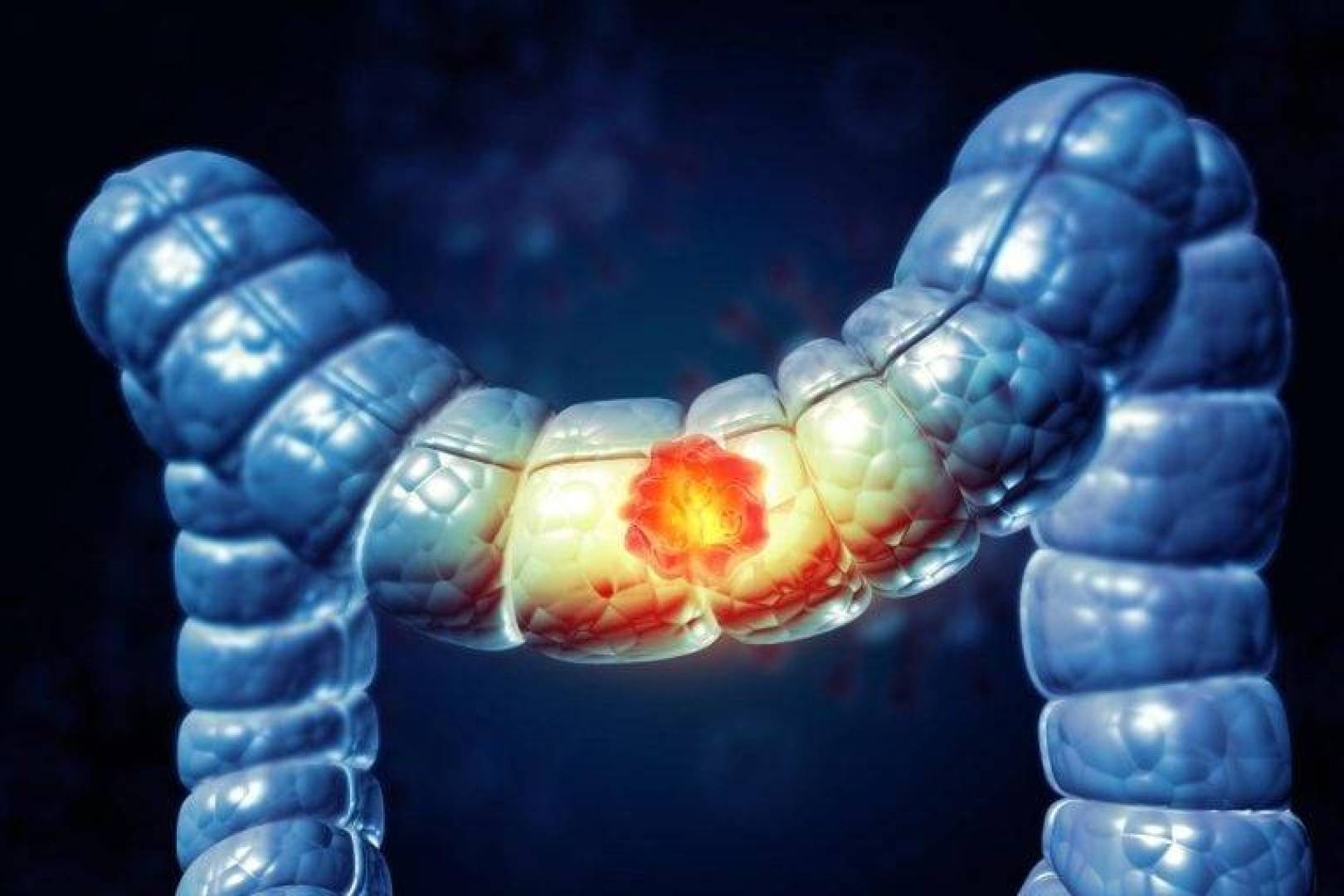 اكتشاف علمي لآلية خفية تستخدمها بكتيريا معوية لإتلاف خلايا القولون