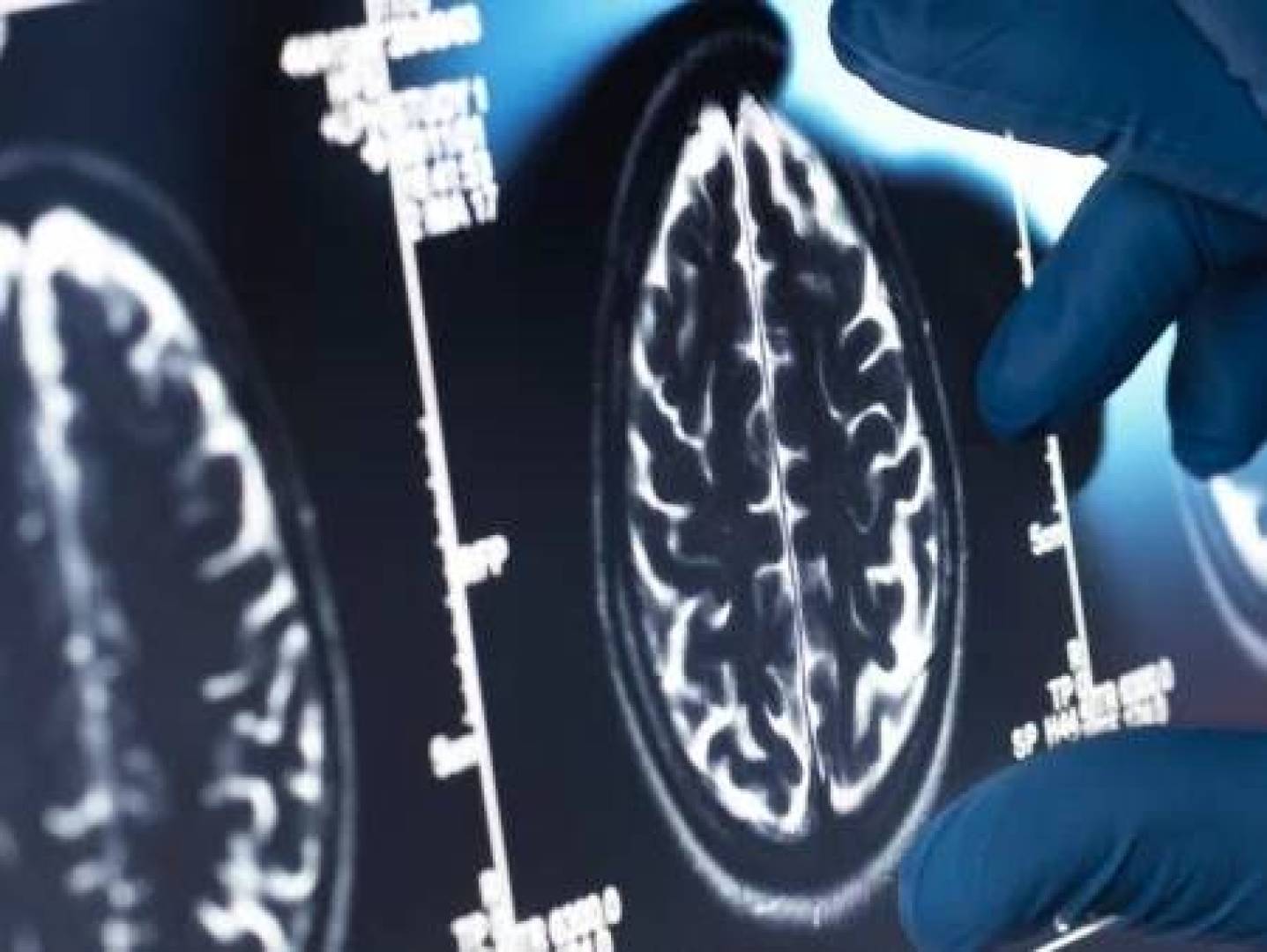 تعرف على كيفية تأثير مسار الاكتئاب في بنية الدماغ