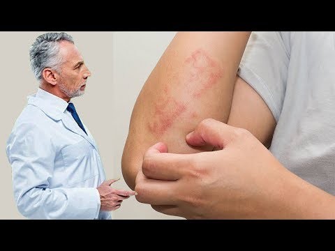هل استمعتم بمرض تعفن الدم, تفاصيل وارقام مرعبة عن عدد ضحاياه