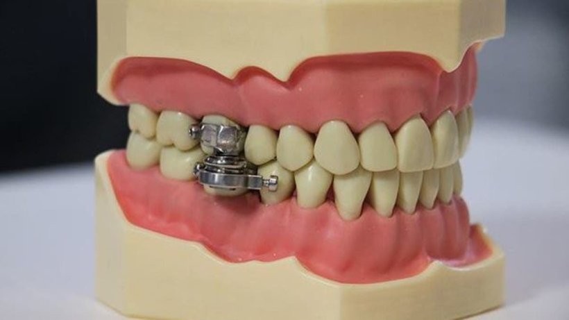 قفل الأسنان... طريقة جديدة لإنقاص الوزن