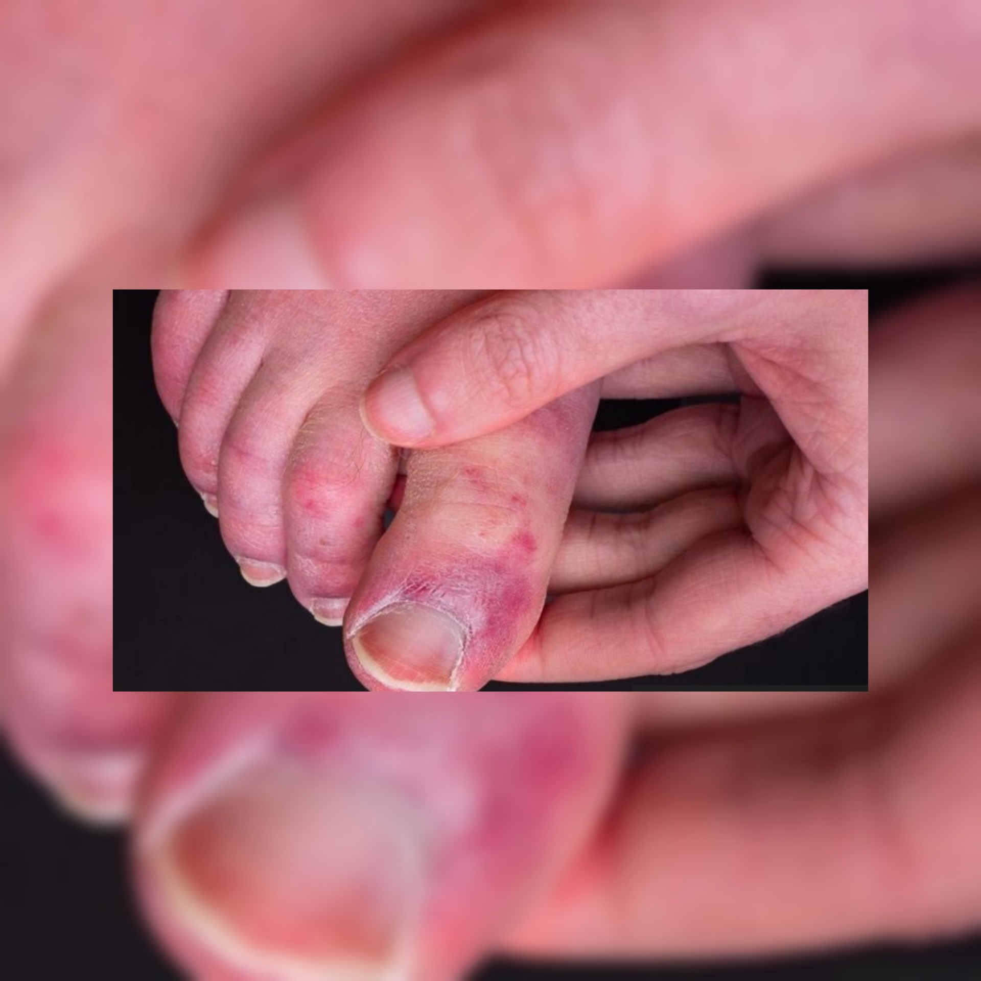فيروس كورونا : دراسة حديثة تكشف أسباب الإصابة بـأصابع كوفيد ..فما هي أصابع كورونا